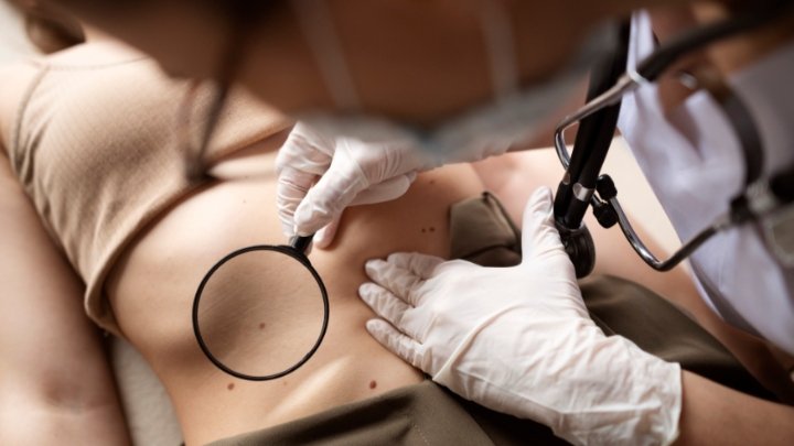 Câncer de pele mais comum no Brasil avança por falsa sensação de segurança, alerta especialista